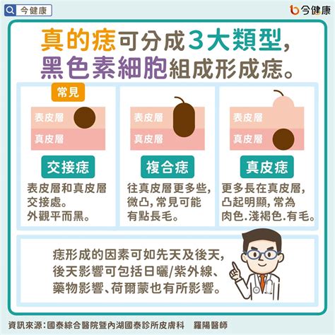 身體 痣|痣是什麼？一次了解痣原因、就醫時機以及如何改善